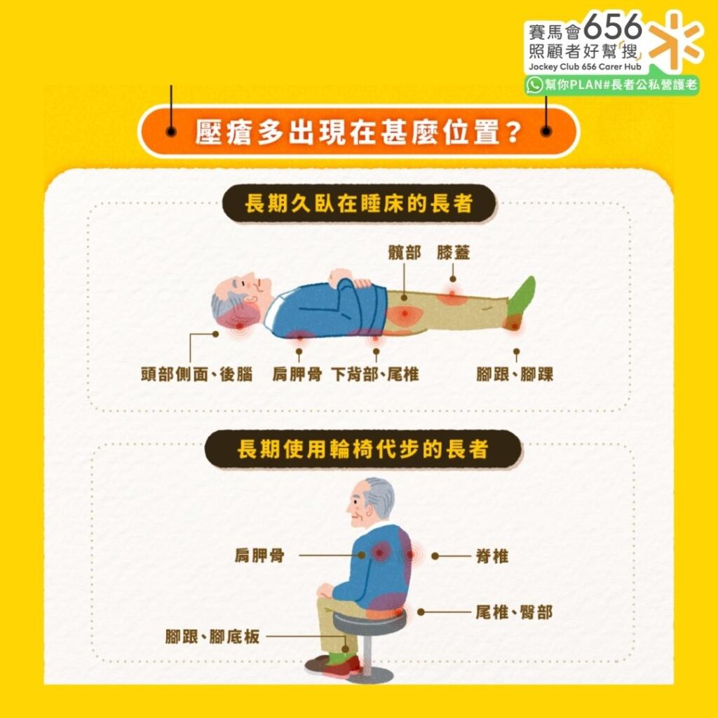 壓瘡多出現什麼位置？