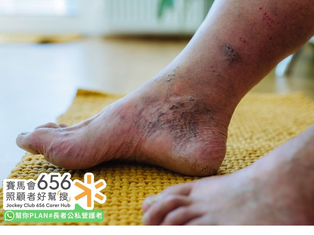 【糖尿病足護理指南】如何辨識糖尿病足初期症狀?日常護理改善及治療方法 3 糖尿病足皮膚異常乾燥與脫皮